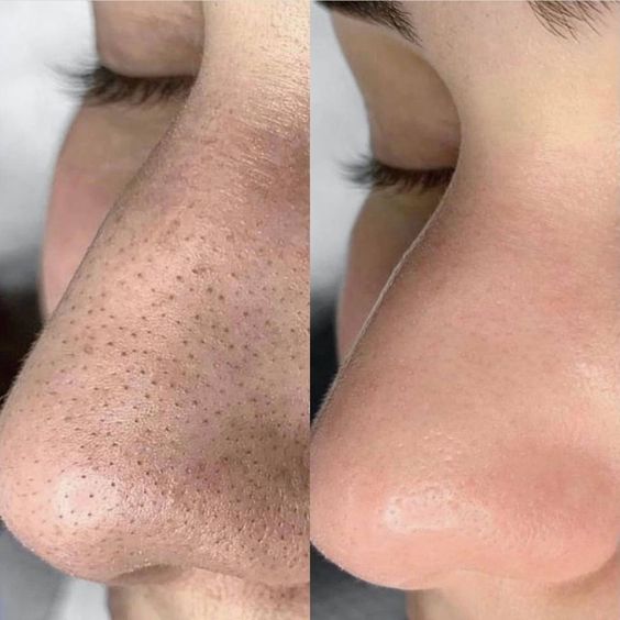 Milky Acne Cleanser - 100ML - PURETE Skin Co.