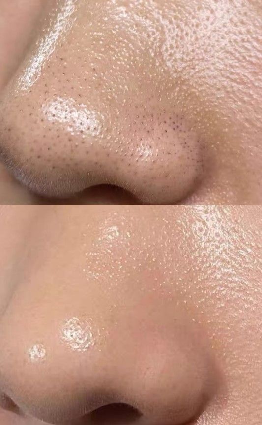 Milky Acne Cleanser - 100ML - PURETE Skin Co.